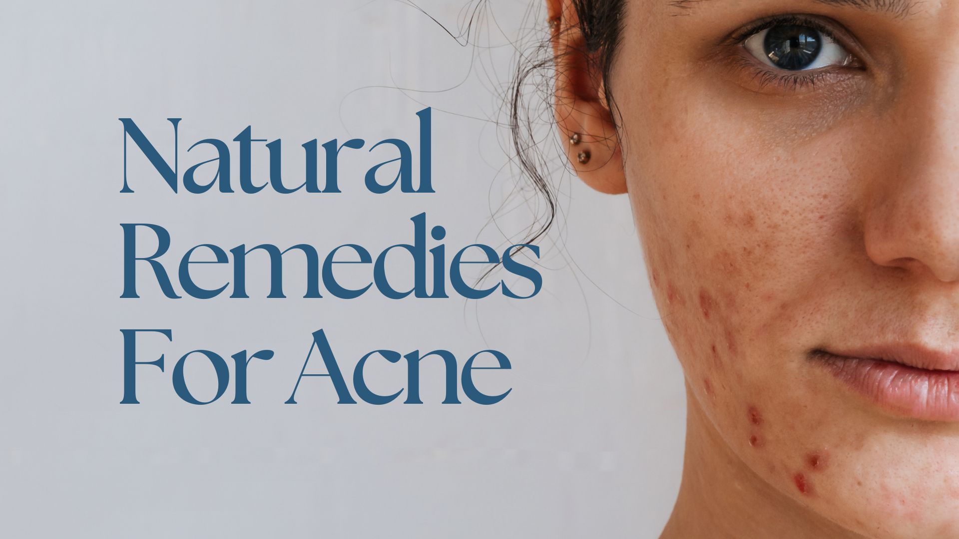 Acne natural remedy