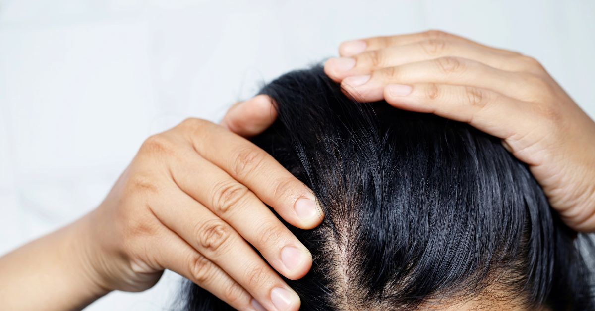 dandruff-natural-remedies