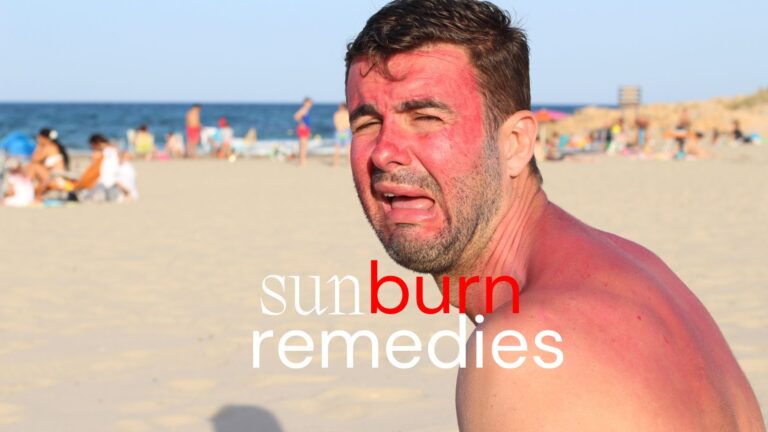 sunburn remedies