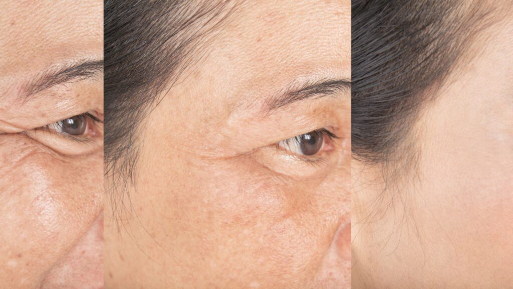 wrinkles remedies